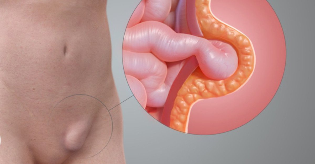 Khối phồng thoát vị bẹn